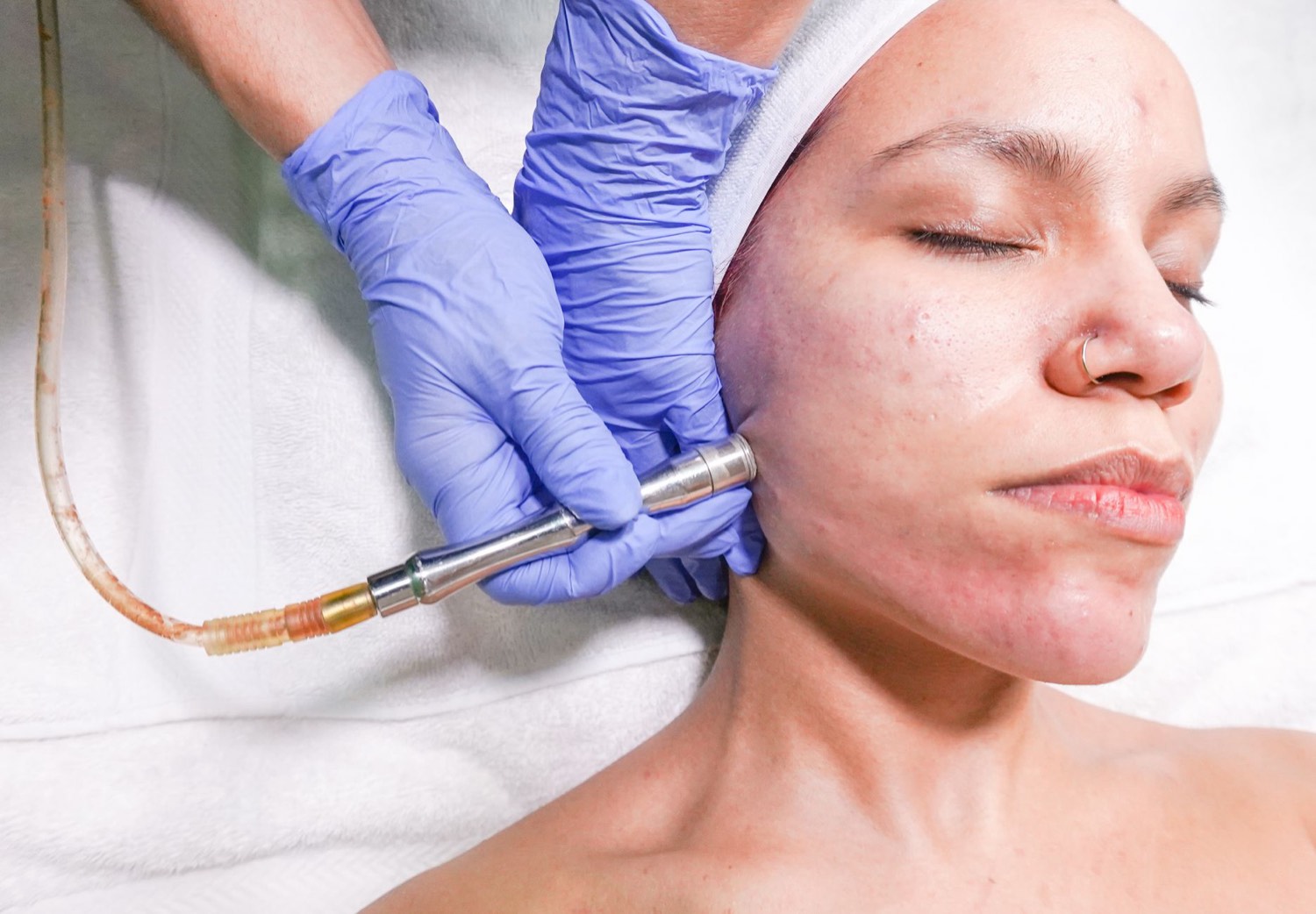 Microdermabrasion skin-resurfacing treatment